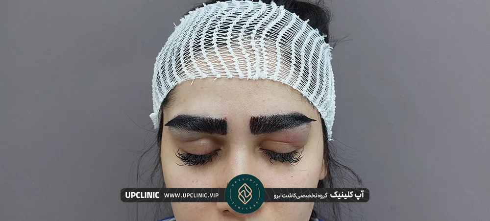 نتایج بعد از کاشت ابروی اس یو تو دختر جوان