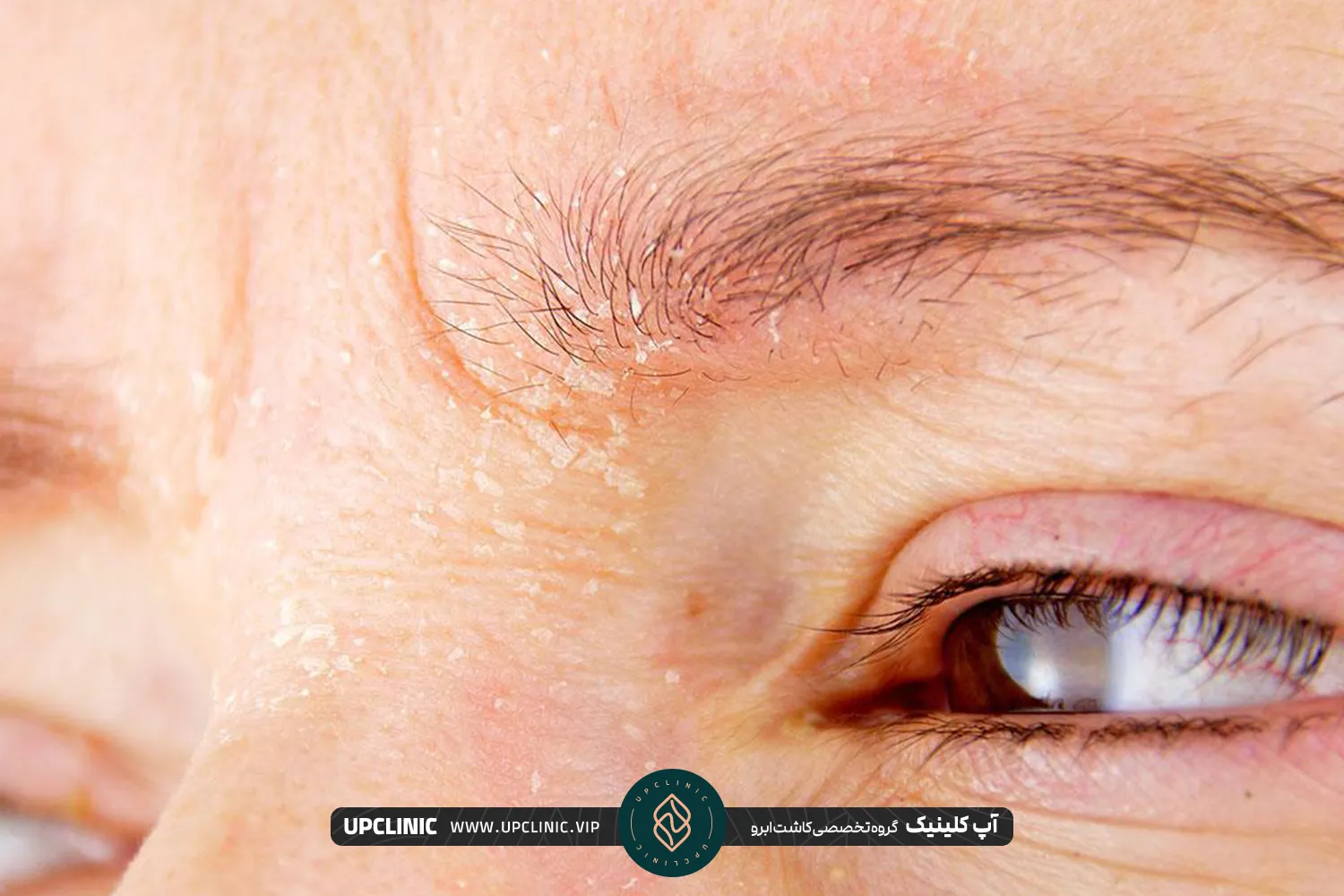 علت پوسته پوسته شدن ابرو بعد از کاشت