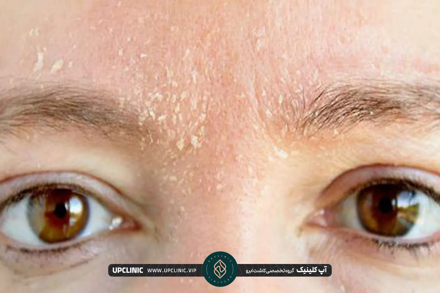 نکات مراقبتی برای جلوگیری از پوسته شدن ابروها بعد از کاشت