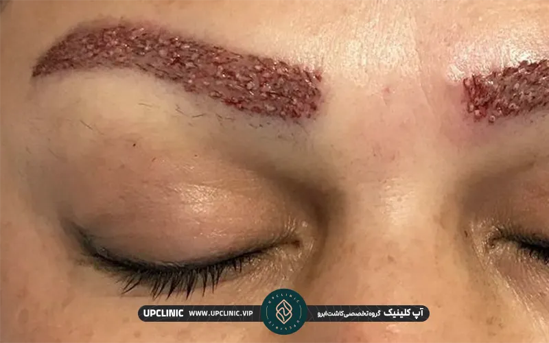 خانمی که تمام ابرو های خود را کاشته است.