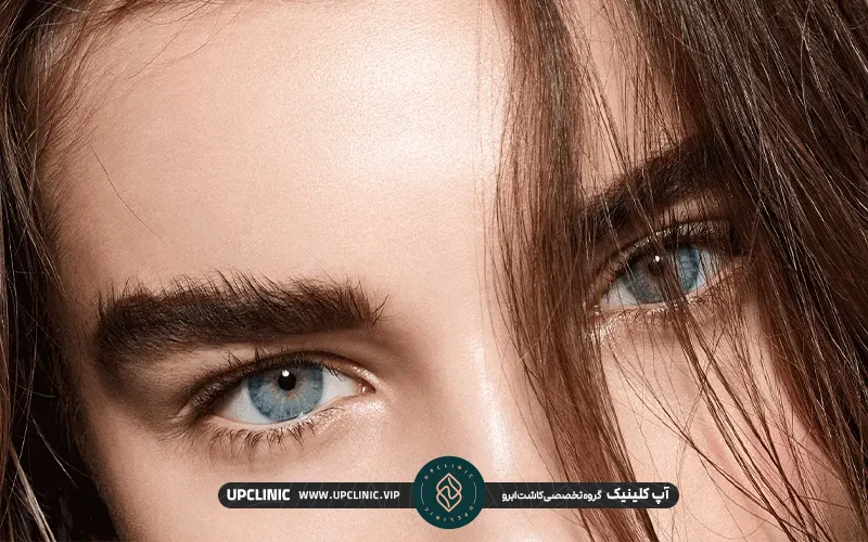 ابروهای کاشته شده یک دختر جوان | مزوتراپی بعد از کاشت ابرو