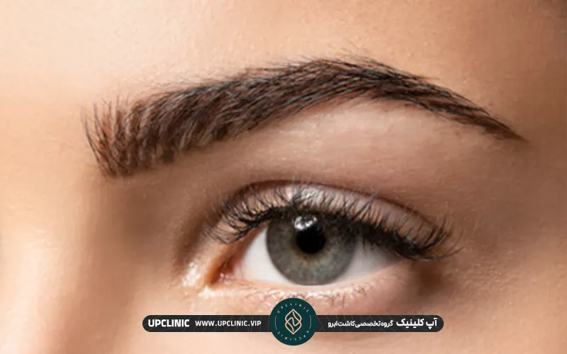 تاثیر تزریق مزوتراپی برای ابروهای کاشت شده